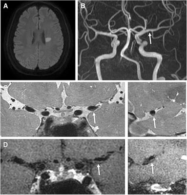 Factors for Enhancement of Intracranial Atherosclerosis in High Resolution Vessel Wall MRI in Ischemic Stroke Patients